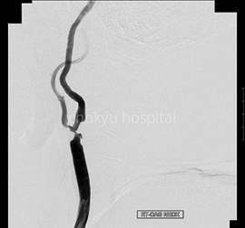 PRE STENT